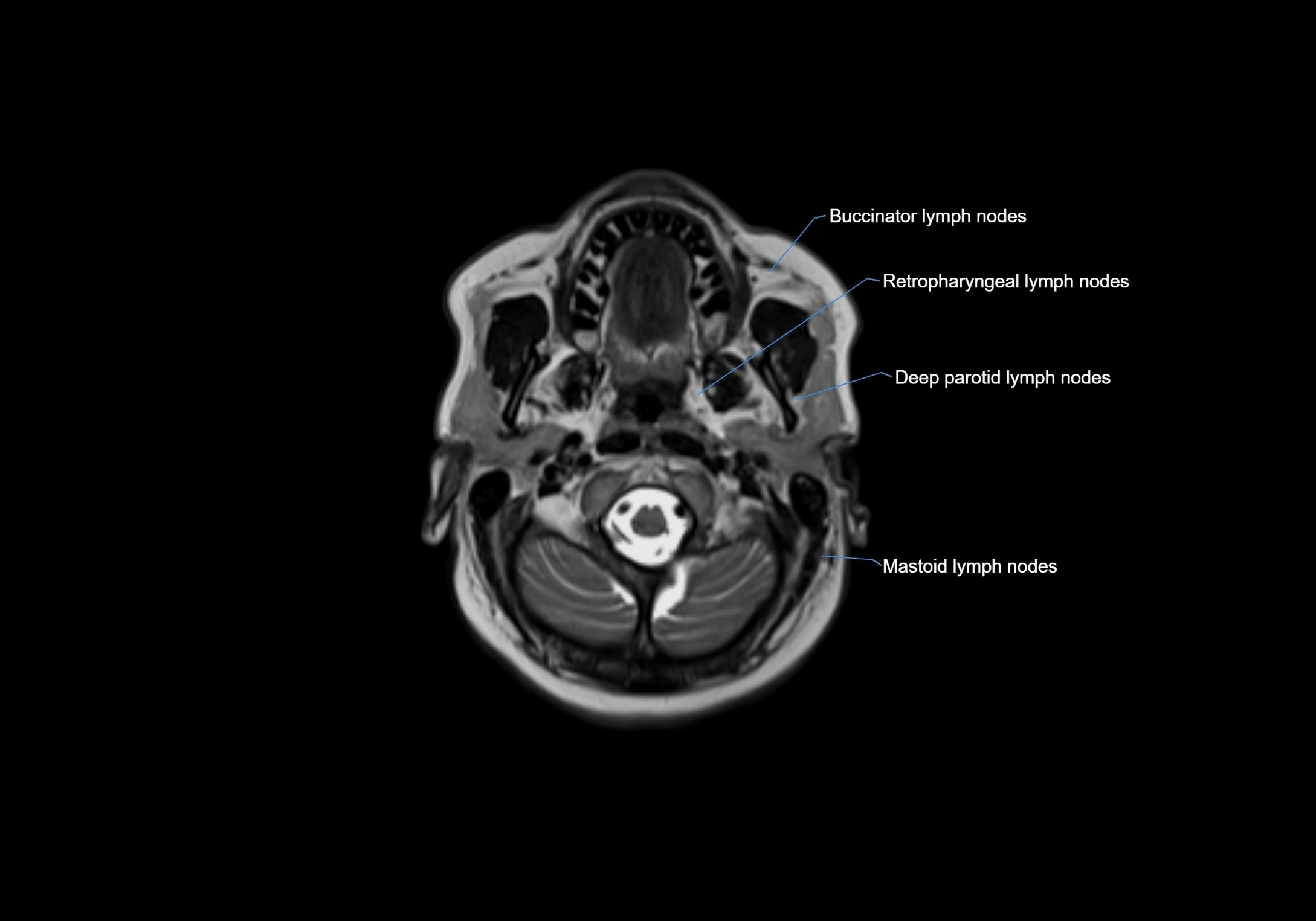 Neck axial  lymph node cross sectional MRI anatomy 3T MRI  image-img-00001-00027.webp